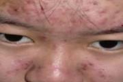 青春痘破了会不会留疤