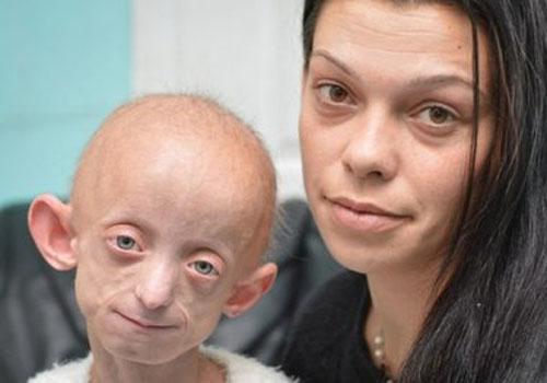 早衰症能活多久