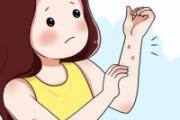 蚊子喜欢什么血型 身上涂什么蚊子不敢靠近