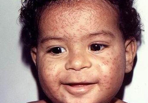 光敏性皮炎。怎么根治,能不能晒太阳?