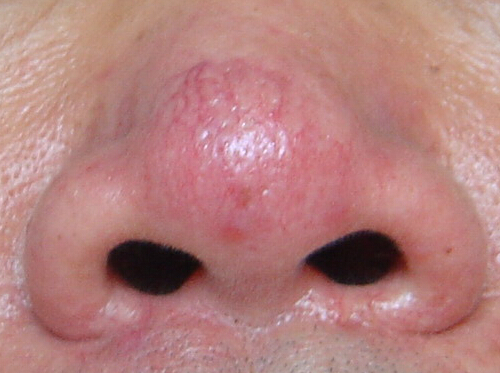 鼻翼两侧发红是怎么回事,鼻子两侧有红血丝是什么原因-乐哈健康网