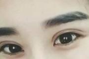 埋线双眼皮能维持多久 埋线双眼皮是永久的么