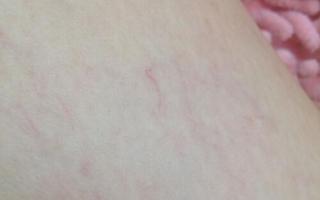 腿上长了很多小红疙瘩很痒怎么办