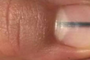 指甲上有黑线是癌症吗 哪种指甲黑线代表癌症