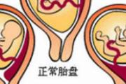 前置胎盘是怎样造成的 提防4大诱因