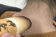 艾灸对慢性咽炎有用吗 慢性咽炎艾灸哪里