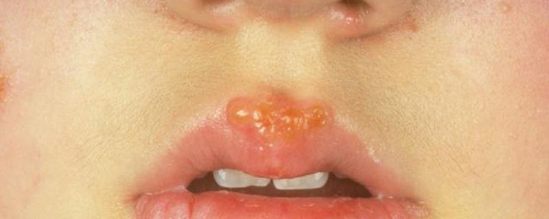 嘴唇上长疱疹会传染吗 嘴唇上长疱疹怎么办 乐哈健康网