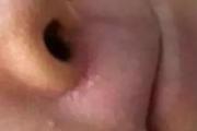 脸上脂肪粒怎么去除 小妙招去除脸上脂肪粒