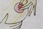 乳头内陷治疗方法