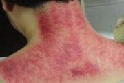颈部刮痧的方法图解 颈部刮痧的好处