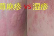 荨麻疹与湿疹的区别是什么