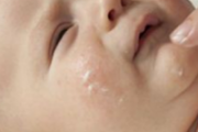 这些都不是婴儿湿疹，妈妈们一定要记住！宝宝疹子有哪几种 