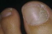 灰指甲不治疗的后果 看完后果千万要马上治疗