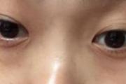 眼睛下面长斑是怎么原因