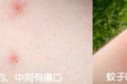 被跳蚤咬了怎么办