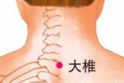 脖子落枕拔罐图片大全 脖子落枕拔罐管用吗