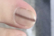指甲有竖纹黑线怎么办 只需3步即可去除竖纹黑线