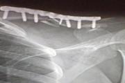 锁骨骨折是做手术好还是保守治疗好 锁骨骨折保守治疗要多久不痛