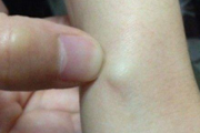 手腕上长了个疙瘩像是骨头 怎么回事？怎么办？