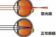 散光的原因 散光眼的治疗方法