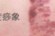 刮痧后第二天背部很痛 怎么回事？该怎么办？