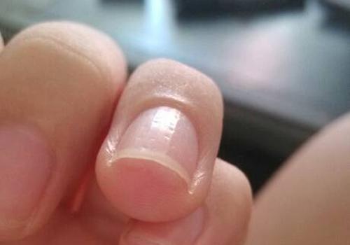 脚趾旁边的肉一按就痛 脚指甲长肉里疼死人只需一招