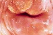 宫颈癌能治好吗