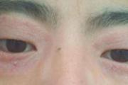 眼睛周围红肿痒起皮怎么回事