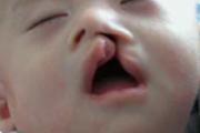 婴儿兔唇是怎么形成的