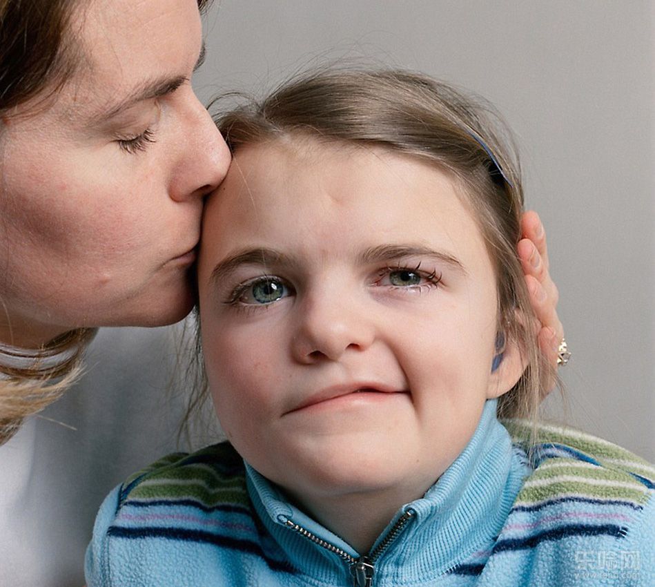 面瘫的症状,面瘫的症状是什么,面瘫后遗症有哪