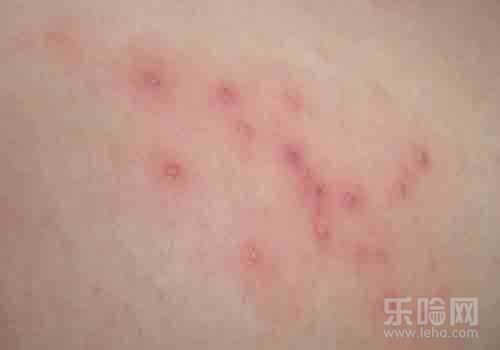 湿疹是怎么引起的,什么是湿疹,湿疹是什么-乐哈