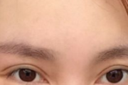 韩式双眼皮效果好吗 韩式双眼皮效果如何