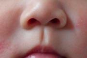 有湿疹了怎么办小妙招 熏洗、刮痧、拔火罐面面俱到