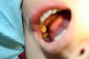 什么情况不能拔牙 拔牙后需要做好以下注意事项