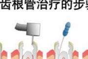 龋齿根管治疗怎么做