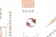 自体脂肪面部填充效果能保持多久