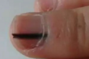 脚指甲里面有黑块不痛 是黑色素瘤吗？怎么治？