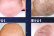 婴儿头睡偏了怎么办