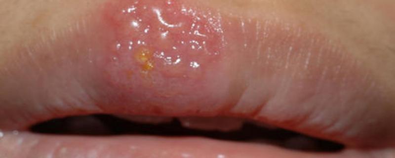 嘴唇上长疱疹会传染吗 嘴唇上长疱疹怎么办 乐哈健康网