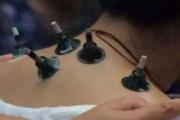 颈椎病艾灸做哪些部位 艾灸颈椎灸哪里