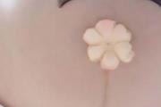妊娠线每个孕妇都有吗