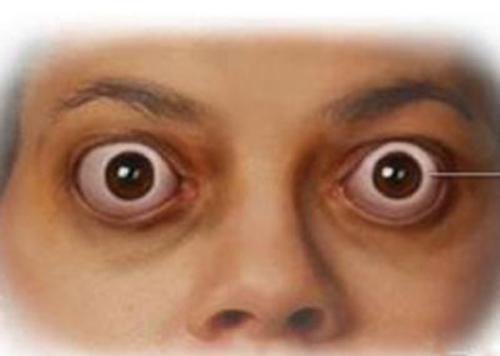 1甲亢引起高血压甲亢患者由于甲状腺激素增多,代2甲亢引起心脏病甲亢